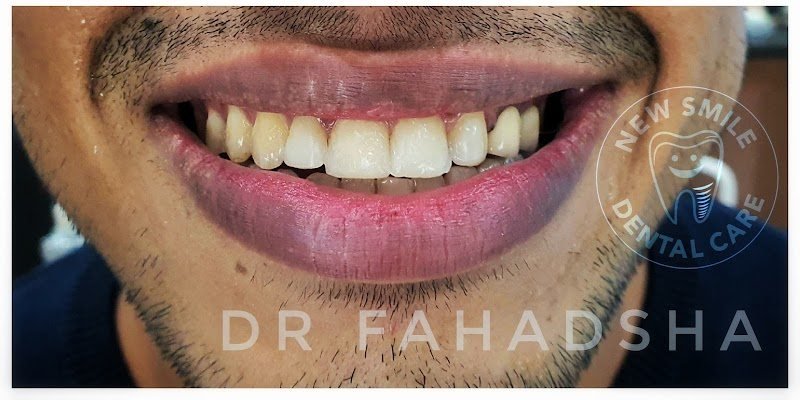 Smile after treatment by Dr. Fahad Sha